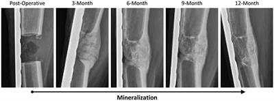 Temporal metabolic profiling of bone healing in a caprine tibia segmental defect model